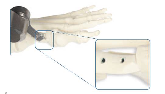 hx-valgus-juanetes